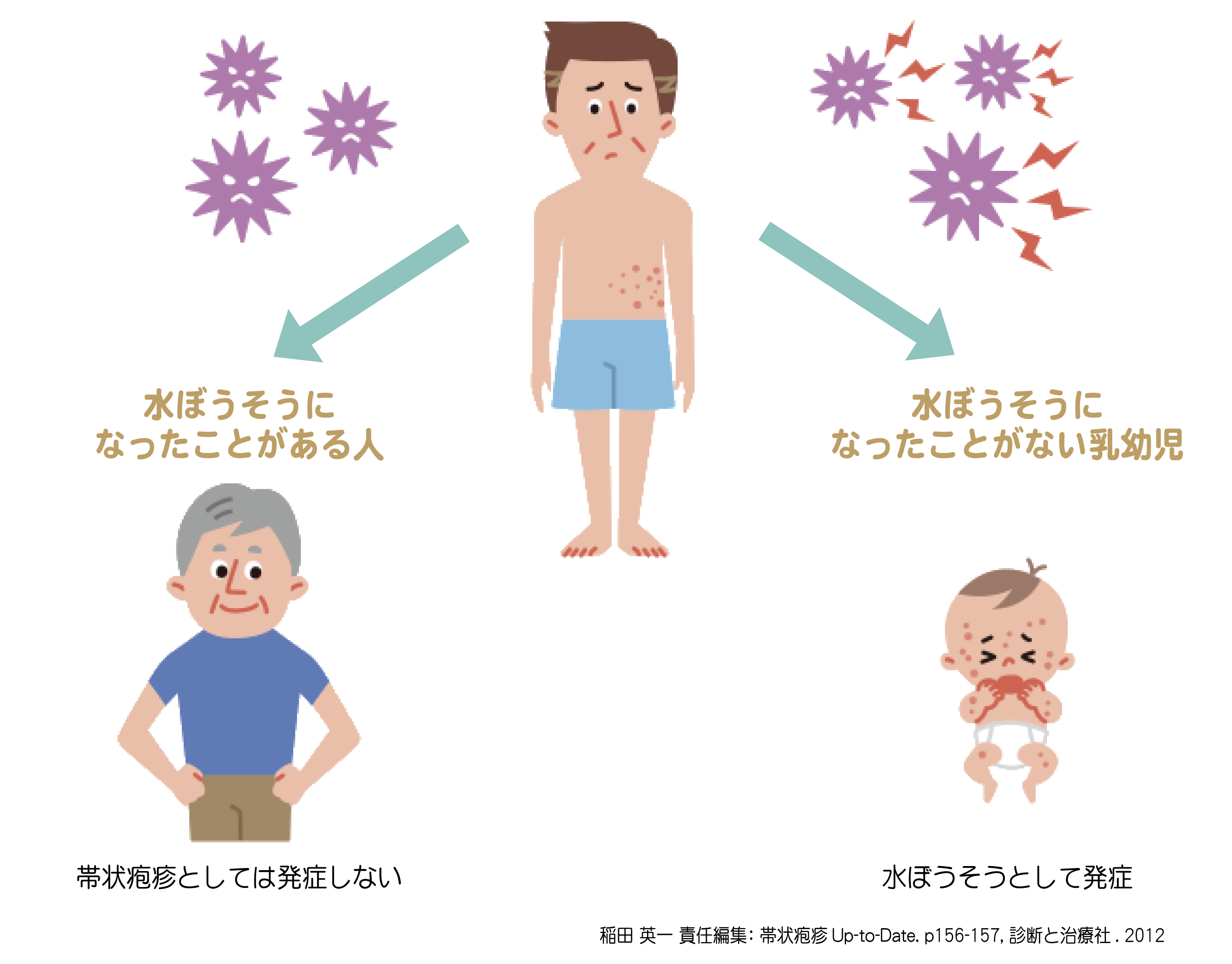 帯状疱疹は人にうつるのか？