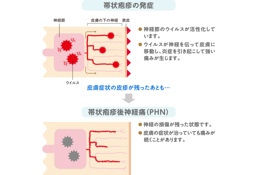 帯状疱疹後神経痛の原因